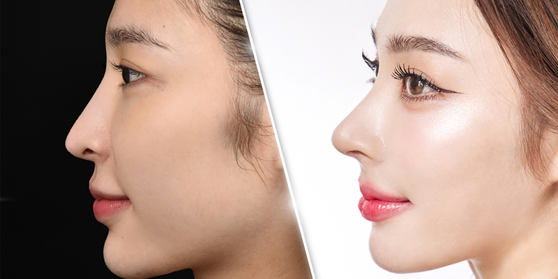 nâng mũi sline cao tây