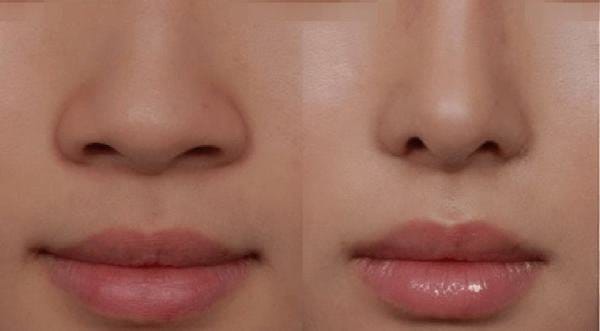 cắt cánh mũi ở đâu đẹp tphcm