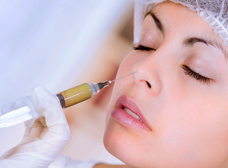 nâng mũi bằng mỡ tự thân