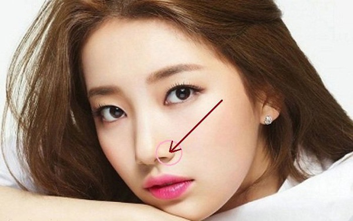 cắt cánh mũi có khó thở không