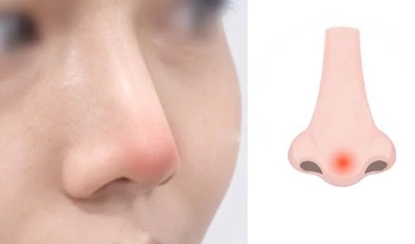 nâng mũi bị đỏ đầu mũi có sao không