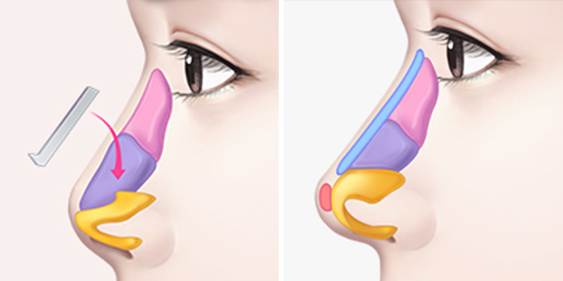 nâng mũi cấu trúc là gì