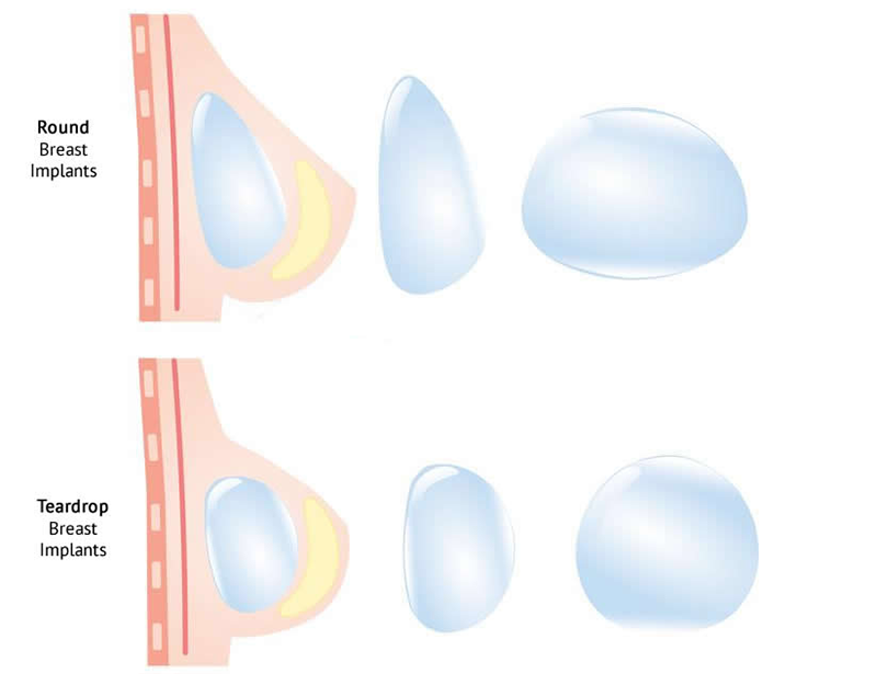 nâng ngực trên cơ và dưới cơ