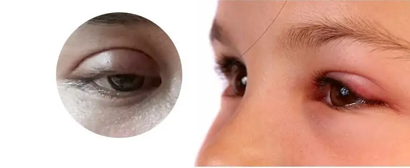 bấm mí mắt bị sưng