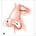 Những điều cần tránh sau khi phẫu thuật nâng mũi bọc sụn