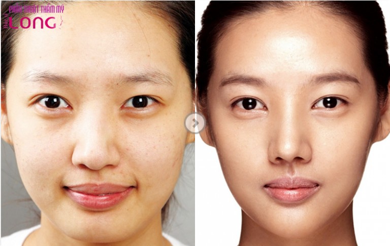 Nâng Mũi Cấu Trúc Giữ Được Bao Lâu?