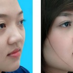 Nâng mũi bằng sụn tự thân hay nhân tạo tốt hơn?