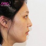 Nâng mũi sụn nhân tạo, phương pháp nâng mũi vĩnh viễn