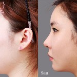 Sửa sống mũi có an toàn không?