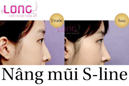 nang-mui-s-line-co-chinh-hinh-vach-ngan-duoc-khong-1