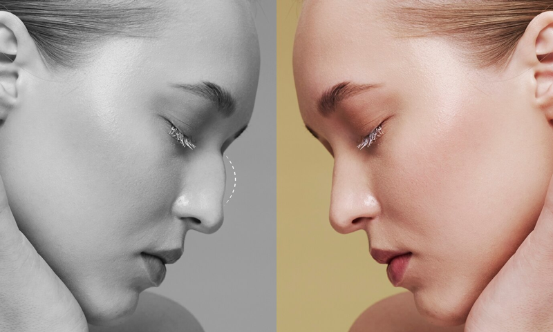 nâng mũi sau này có phải rút ra không