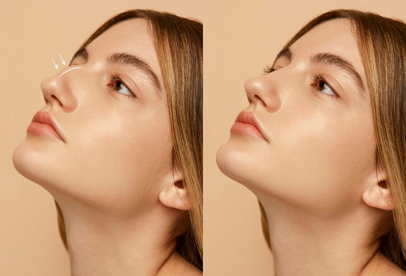 nâng mũi cao có sao không