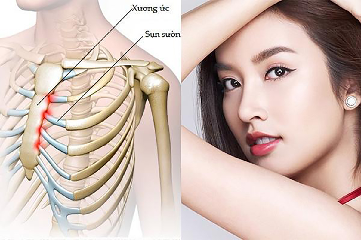 nâng mũi sụn suòn